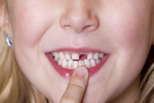Mơ thấy rụng răng là điểm báo gì